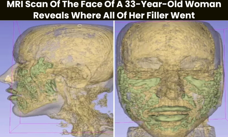 MRI Scan Of The Face Of A 33-Year-Old Woman Reveals Where All Of Her Filler Went