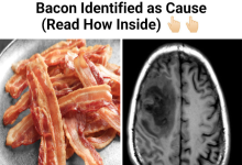 Worm Eggs Found in Mans Brain After Migraines Undercooked Bacon Identified as Cause