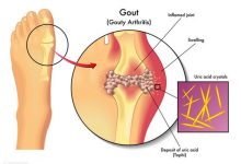 How To Quickly Remove Uric Acid Crystallization From Your Body To Prevent Gout And Joint Pain