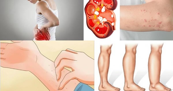 If Your Kidney Is in Danger the Body Will Give You These 8 Signs3