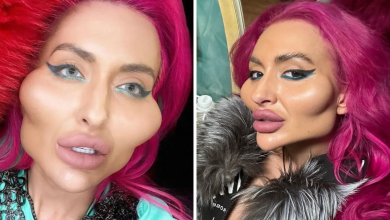 Model With Worlds Biggest Cheeks Shares Unrecognisable Photos From Before Transformation